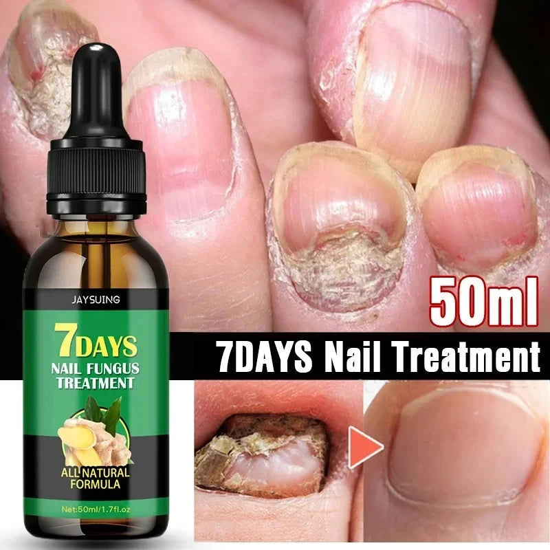 7 Days Nail Fungal Treatment Essence Oil Foot