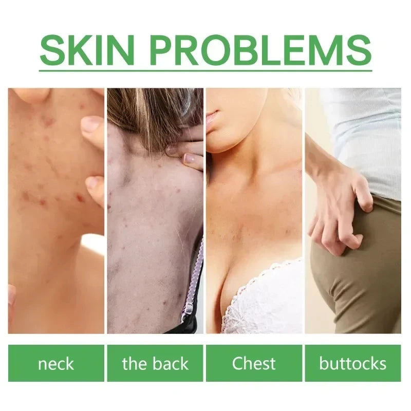 Buttock Acne Removing Serum – Whitening Essence to Fade Acne Scars, Dark Spots & Melanin, Moisturizing Skin Care Lotion