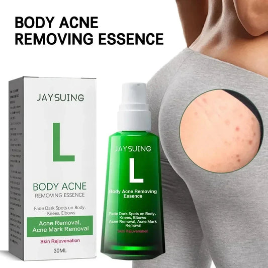 Buttock Acne Removing Serum – Whitening Essence to Fade Acne Scars, Dark Spots & Melanin, Moisturizing Skin Care Lotion