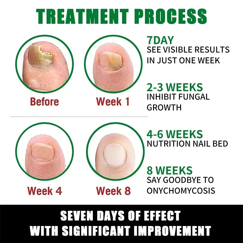 7 Days Nail Fungal Treatment Essence Oil Foot