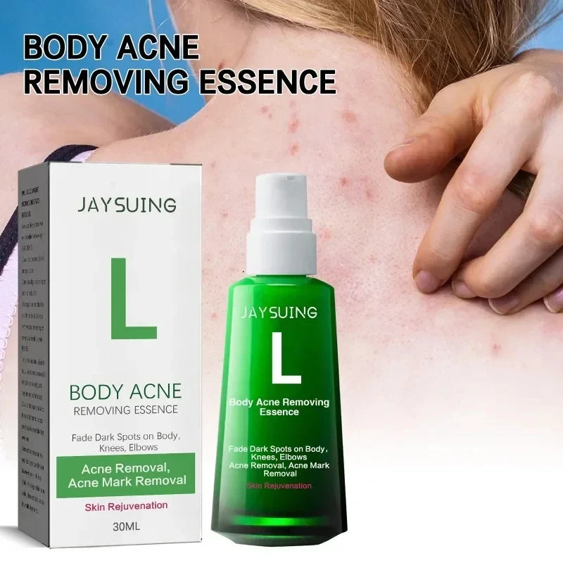 Buttock Acne Removing Serum – Whitening Essence to Fade Acne Scars, Dark Spots & Melanin, Moisturizing Skin Care Lotion