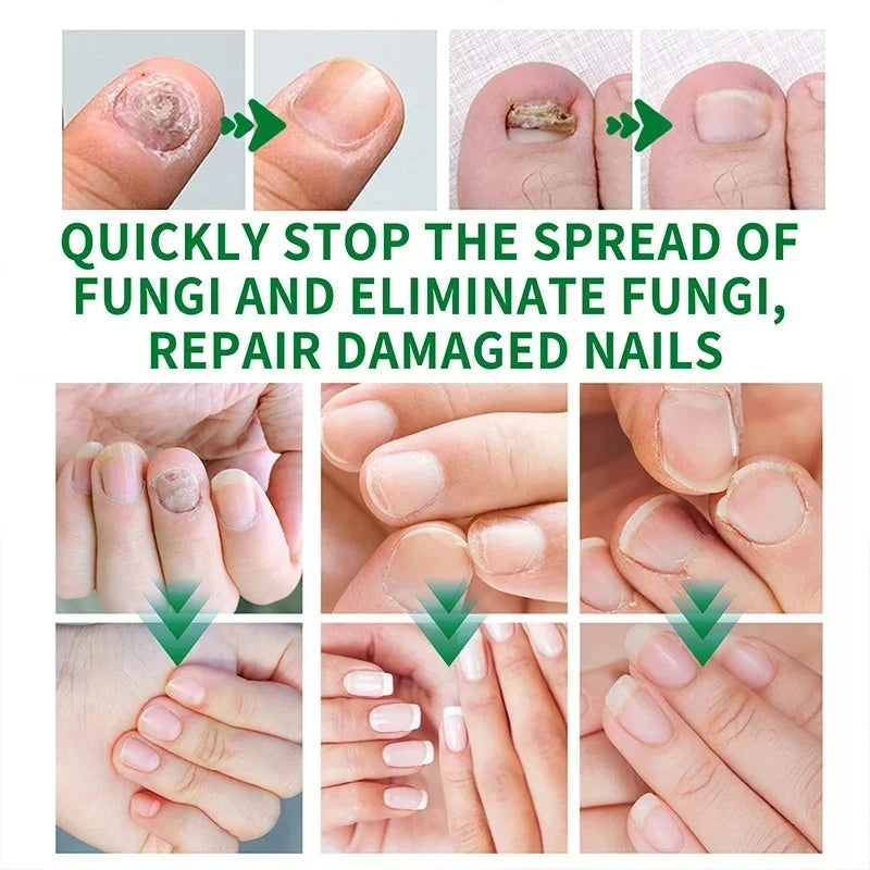 7 Days Nail Fungal Treatment Essence Oil Foot