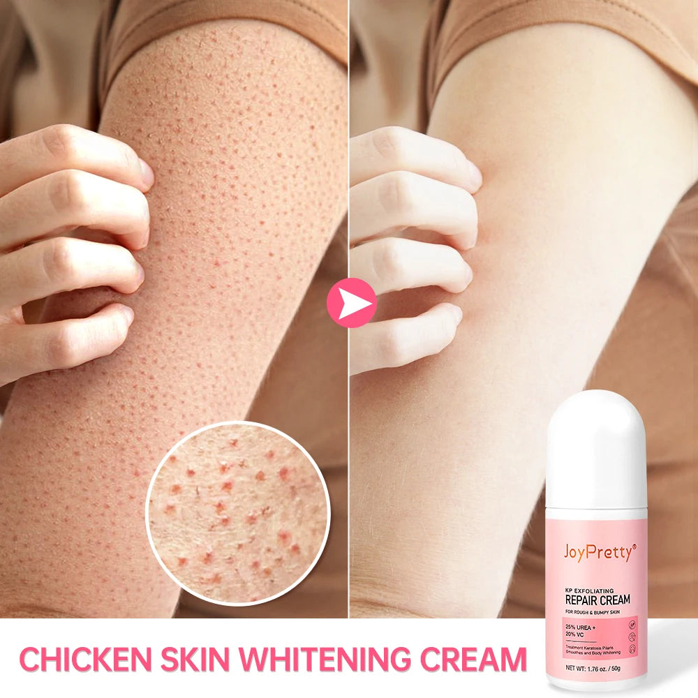 "Chicken Skin" Removal Body Cream