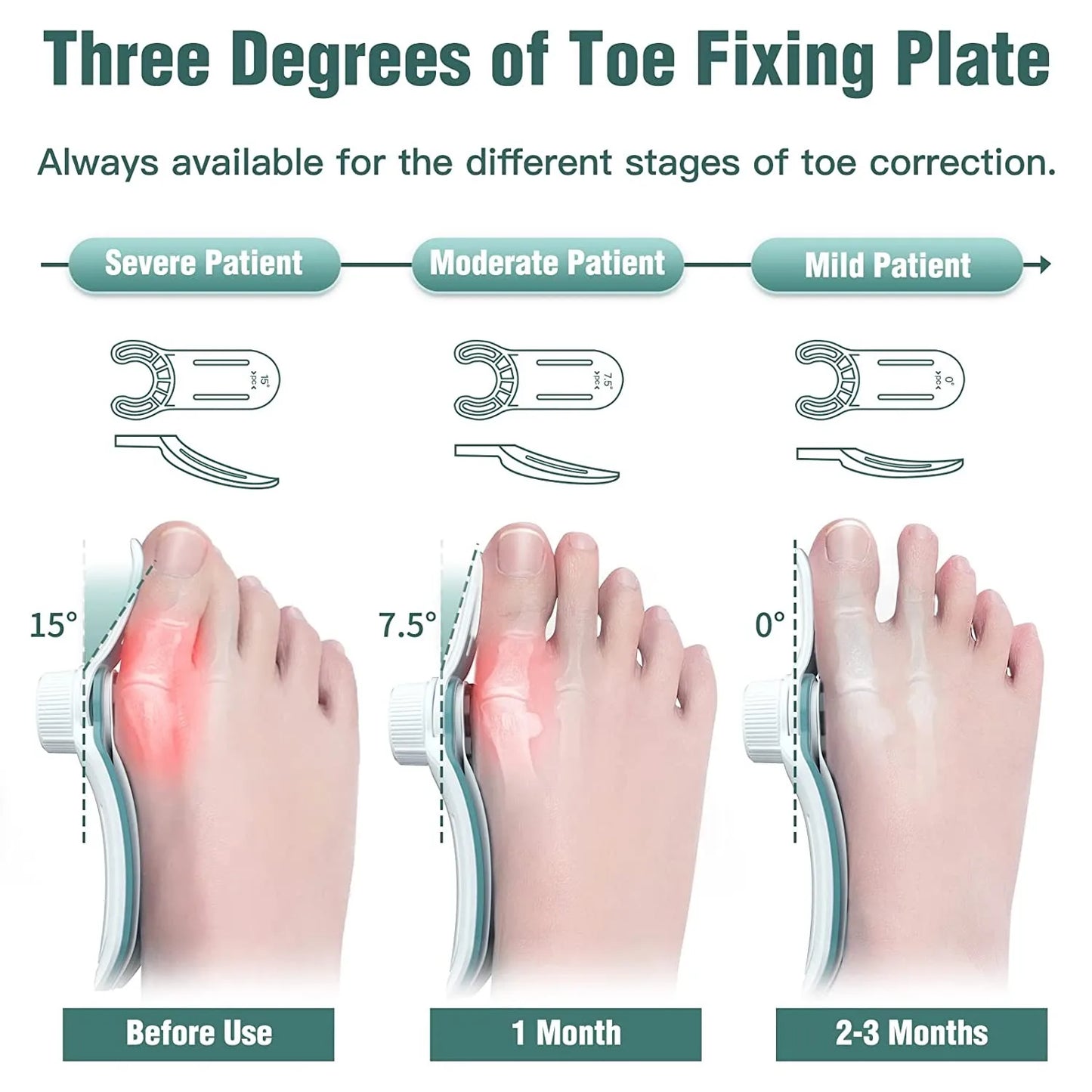 Foot Care Bunion Corrector - Orthopedic Bunion Splint for Hallux Valgus with Three-Angle Fixation Correction Straightener