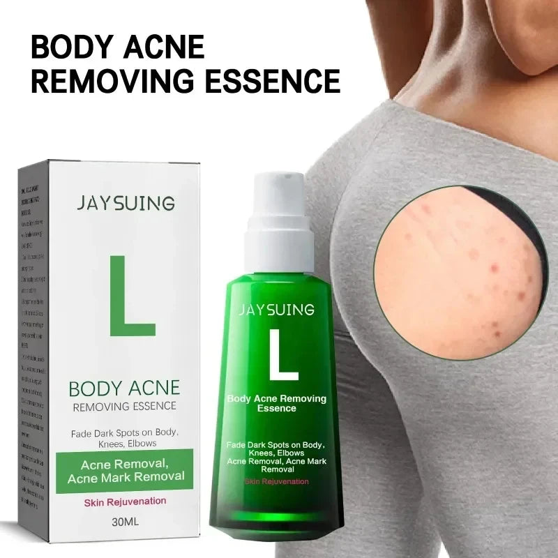 Buttock Acne Removing Serum – Whitening Essence to Fade Acne Scars, Dark Spots & Melanin, Moisturizing Skin Care Lotion